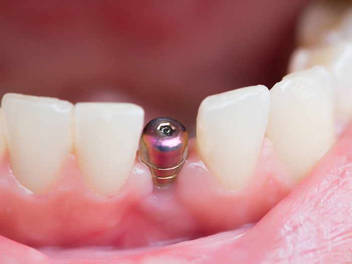Dental Implants