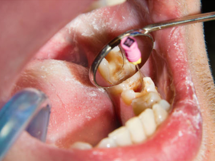 Root Canal Treatment