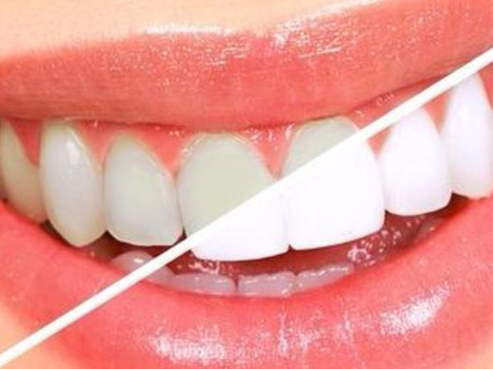 Dental Filling