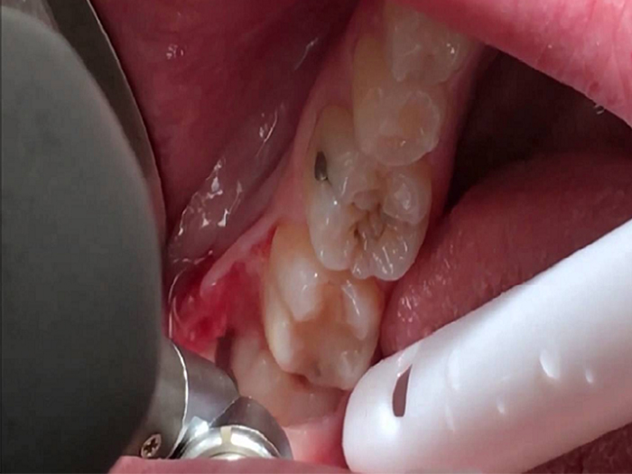 Wisdom Teeth Removal