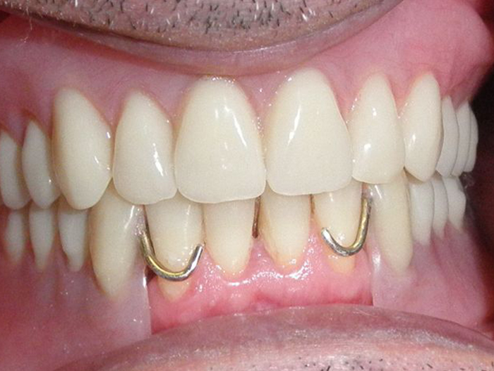 Dentures