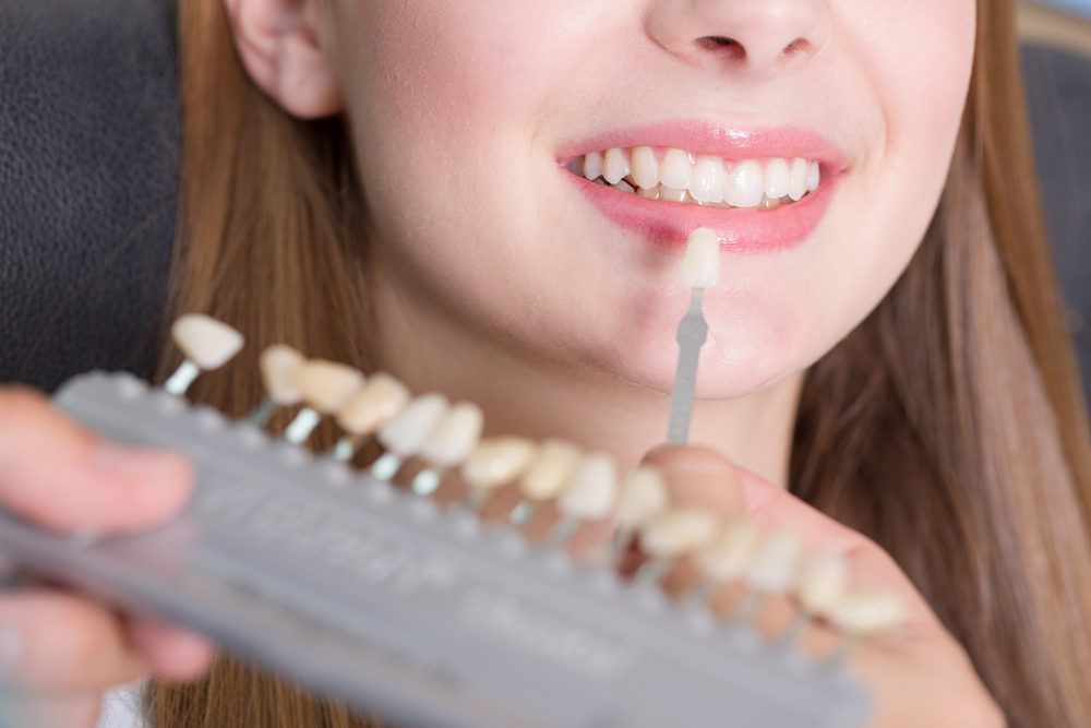 3-reasons-why-you-should-choose-dental-veneers