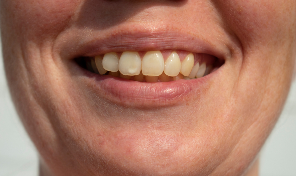 what-you-should-know-about-white-spots-on-your-teeth