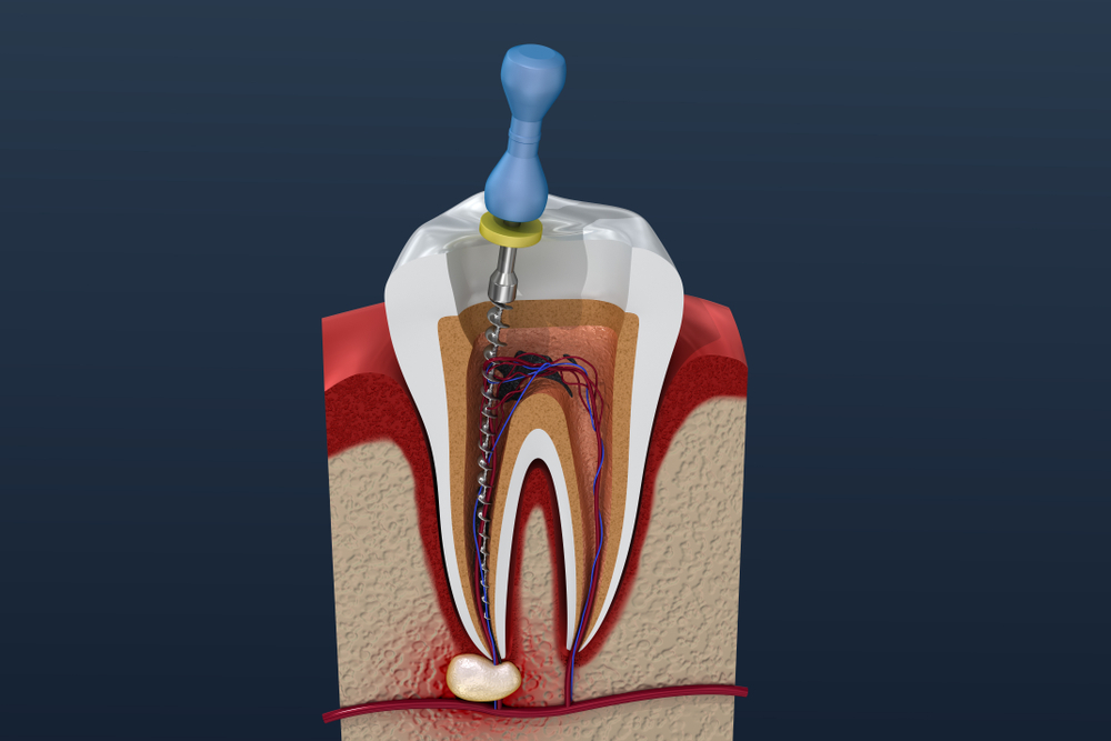 root-canal-treatment-and-things-you-need-to-know-2020