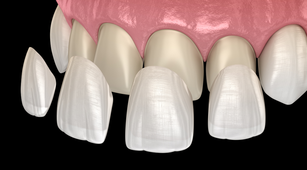 dental-veneers-and-frequently-asked-questions-devshree-dental-care