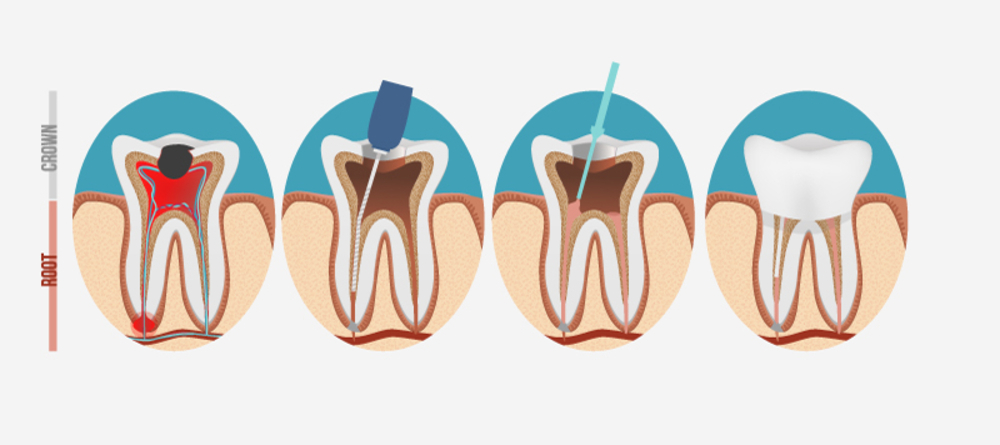 we-debunk-10-myths-on-root-canal-treatment-procedure