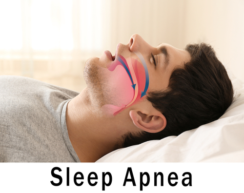 what-is-sleep-apnea-and-how-it-affects-your-sleeping
