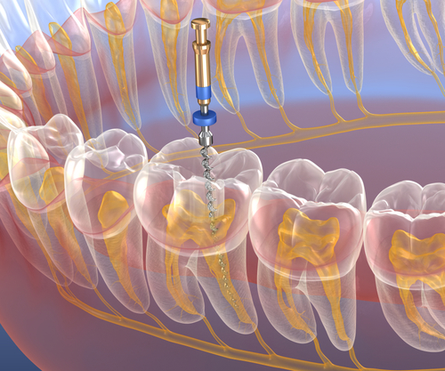 top-10-ways-you-can-avoid-root-canal-treatment