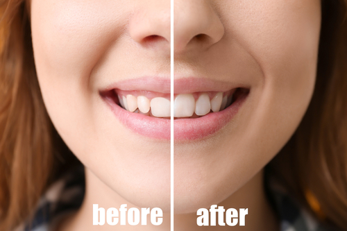 gum-contouring-and-its-3-benefits