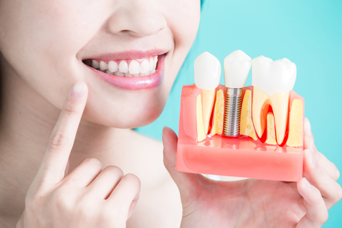 4-tips-to-avoid-infection-in-your-dental-implants