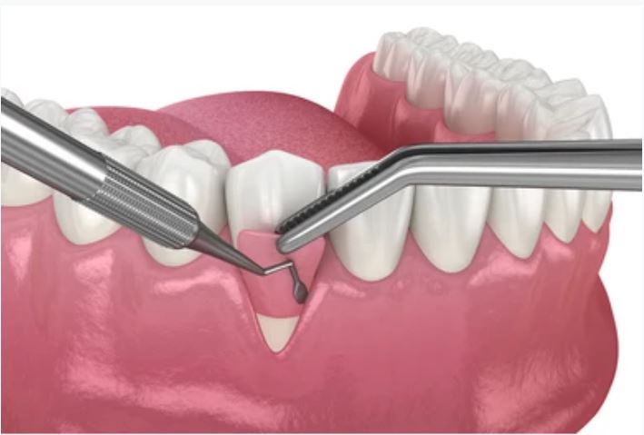6-tips-to-prevent-gums-from-receding