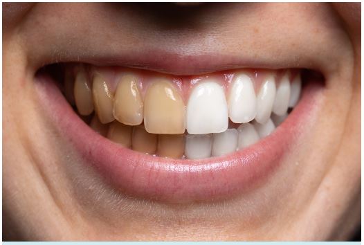 what-are-tooth-stains-reasons-behind-tooth-stains